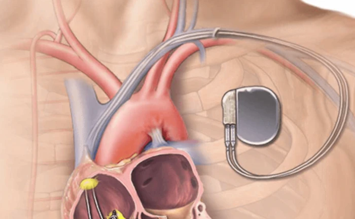 Com funciona un marcapassos: el director d’orquestra invisible del cor